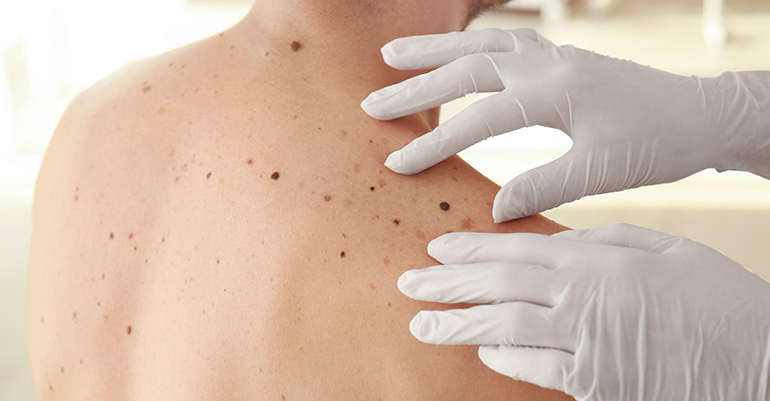Los farmacéuticos y empresas de la salud: Aliados clave en la prevención del cáncer de piel